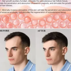 2023 Newest 540pins EMS Derma Roller Micro Current Microneedling Roller with Red Blue Light Therapy and Vibration Bio Roller G5